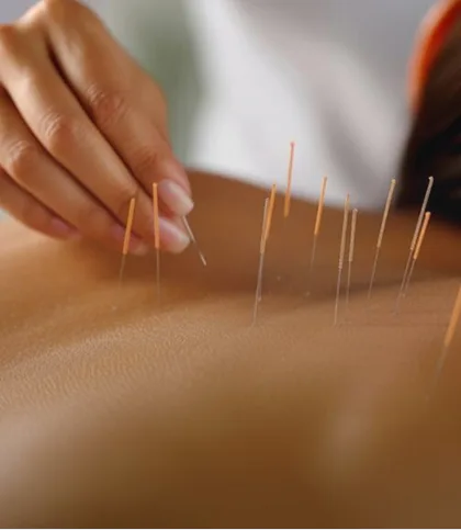 Acupuncture